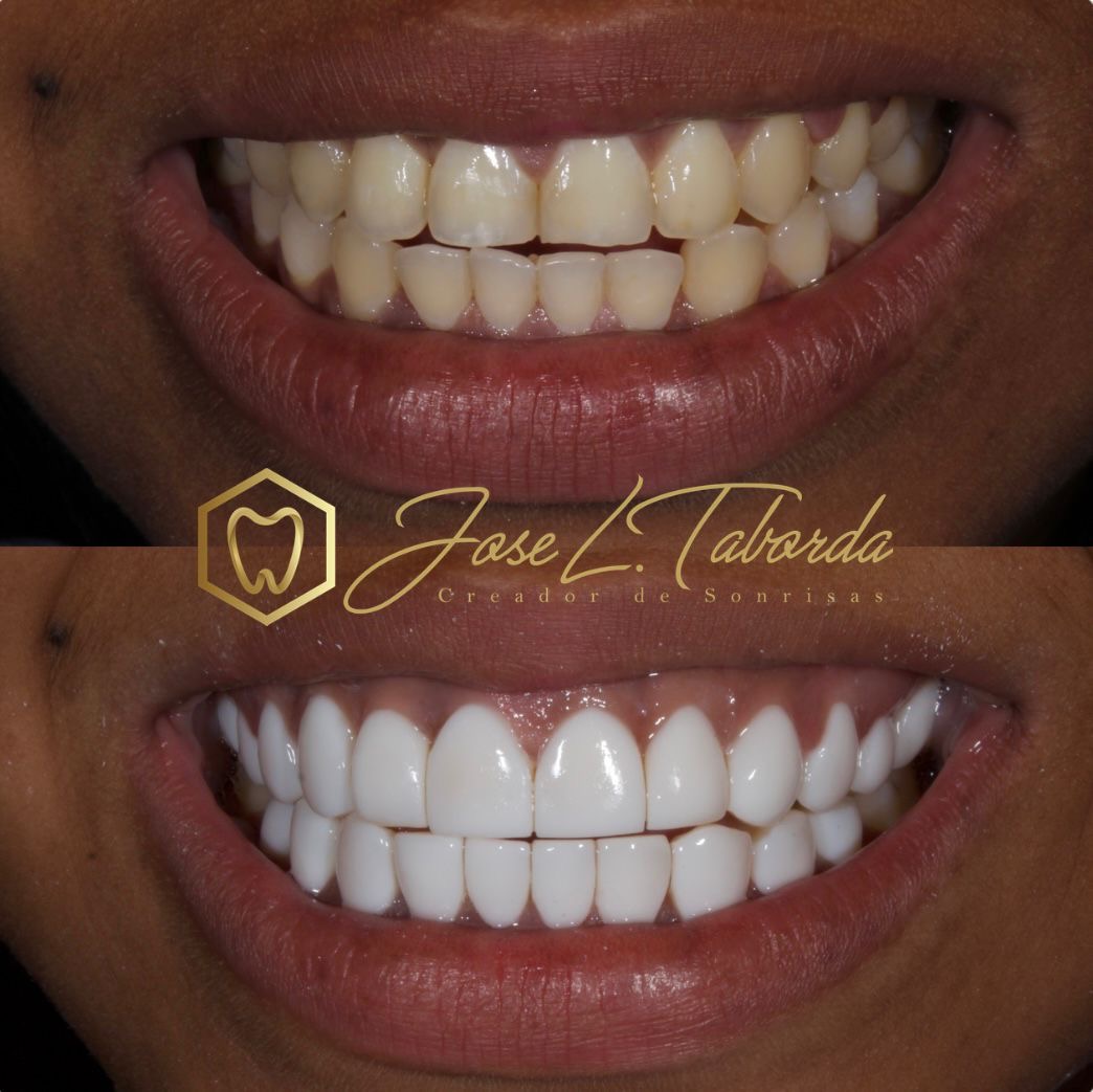Diseño de sonrisa natural en resina - Antes y Después por Dr. Taborda
